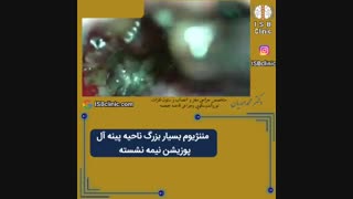 مننژیوم بزرگ