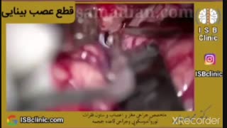 قطع عصب بینایی