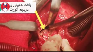 ترمیم فیستول و آبسه آئورت و تعویض دریچه بدنبال اندوکاردیت عفونی  ( فیلم عمل قلب باز)
