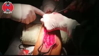 پیوند عروق قلب چگونه انجام می شود؟