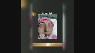 بلافاصله بعد از جراحی بینی