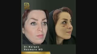 فیلم کامل بلافاصله بعد از برداشتن اسپیلیت بینی