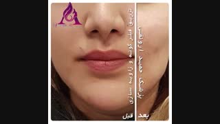 تزریق فیلر گونه و زاویه سازی