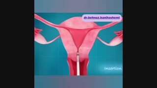 دستگاه جلوگیری از بارداری IUD