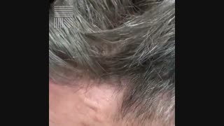 پروتز مو سر 09198858620