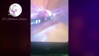 لاپاراسکوپی رحم تک شاخ