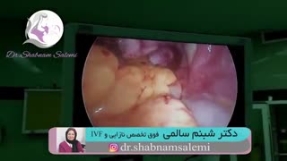 عمل لاپاراسکوپی فیبروم