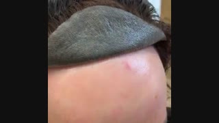 پروتز مو افراد مشهور  09198858620