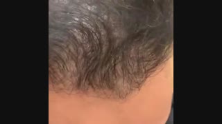 درمان طاسی سر 09198858620