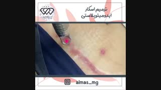فیلم ترمیم جای بخیه ابدومینوپلاستی با لیزر فوتونا