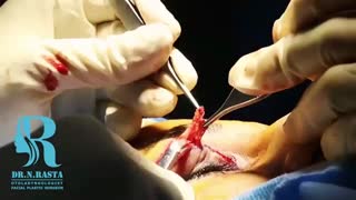 فیلم بلفاروپلاستی و جراحی بینی همزمان