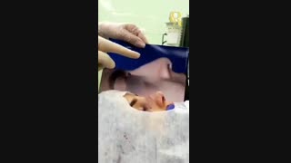 فیلم عمل بینی استخوانی غضروفی