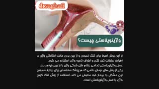 واژینوپلاستی چیست؟؟