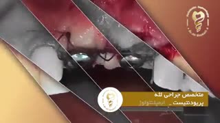 فیلم واقعی ایمپلنت دندان جلو و تغییرات بعد از آن