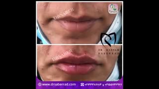 فیلر لب