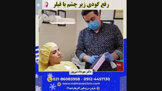 رفع گودی زیر چشم با تزریق فیلر