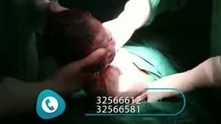 سزارین به دلیل کندگی جفت