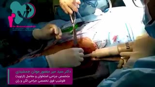 سیمان گذاری در تعویض مفصل لگن