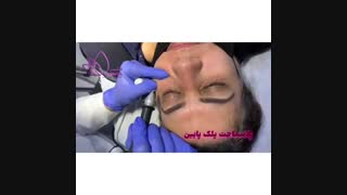 پلاسماجت پلک پایین کلینیک زیبایی