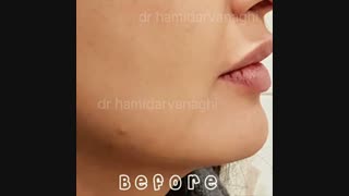 مدلینگ چانه با فیلر هایفوتراپی