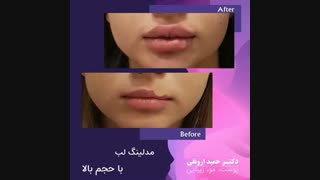 فیلم واقعی حجم دهی لب