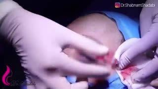 بلفاروپلاستی پلک بالا