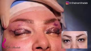 عمل زیبایی پلک بالا