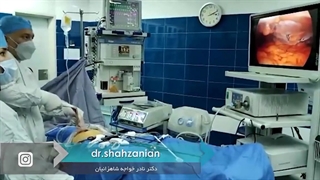 کیست بزرگ لگن و پهلوی چپ با روش لاپاراسکوپی