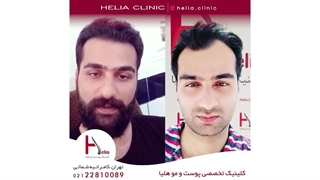 کاشت مو به روش sut در کلینیک هلیا - نظرات افرادی که کاشت مو انجام داده اند.