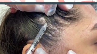 فیلم واقعی درمان میگرن با تزریق بوتاکس