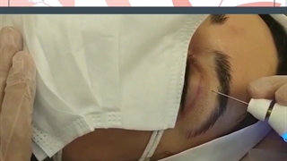 فیلم درمان افتادگی پلک بدون جراحی