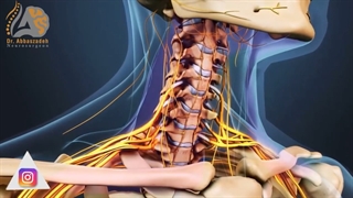 انیمیشن جراحی تخلیه دیسک گردن