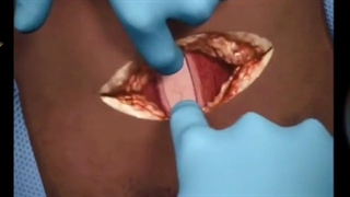 فیلمی واقعی از مراحل زایمان سزارین