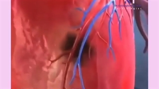 فیلم پلاک چربی داخل عروق قلب و سکته قلبی