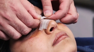 فیلم چگونگی چسب زدن بینی بعد از عمل