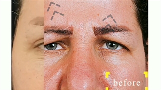 فیلم لیفت ابرو