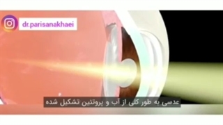 همه آنچه درمورد آب مروارید باید بدانید