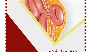 فتق جداره شکم