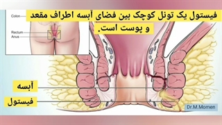 فیستول مقعد چیست و چه علائمی دارد؟