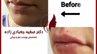 فیلم قبل و بعد تزریق ژل لب