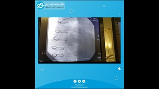 آنژیوپلاستی بیمار 82 ساله با سابقه جراحی قلب باز