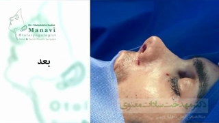 جراحی بینی فانتزی