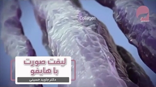 لیفت صورت با هایفوتراپی