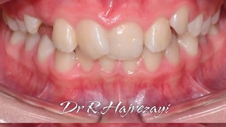 درمان ارتودنسی ثابت دو فک بدون کشیدن دندان | کلینیک تخصصی دندانپزشکی کانسپتا