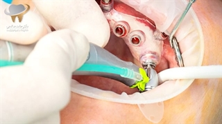 ایمپلنت دیجیتال - بخش دوم | دکتر حامد صالحی