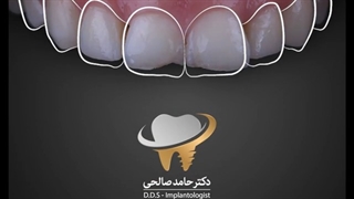 انجام 8 واحد لمینیت سرامیکی به همراه لیفت لثه توسط لیزر | دکتر حامد صالحی