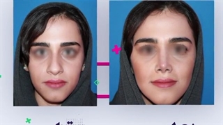 فیلم عمل بینی گوشتی با نتیجه بینی طبیعی
