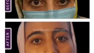 ️جراحی افتادگی پلک از نوع پتوز