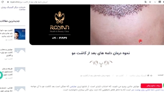 دلمه کاشت مو