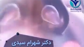 عطسه